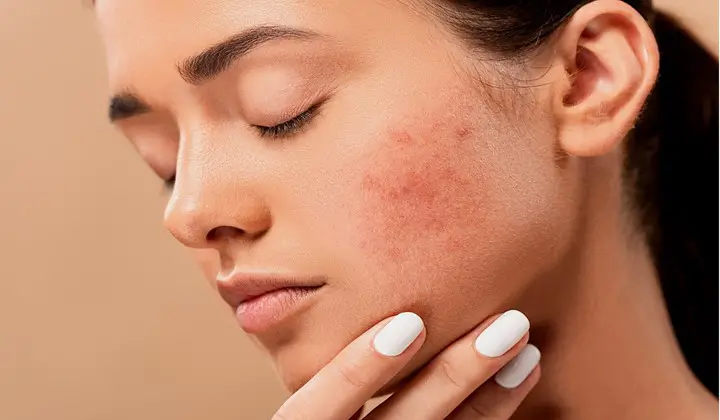 You are currently viewing 8 Best things for acne
